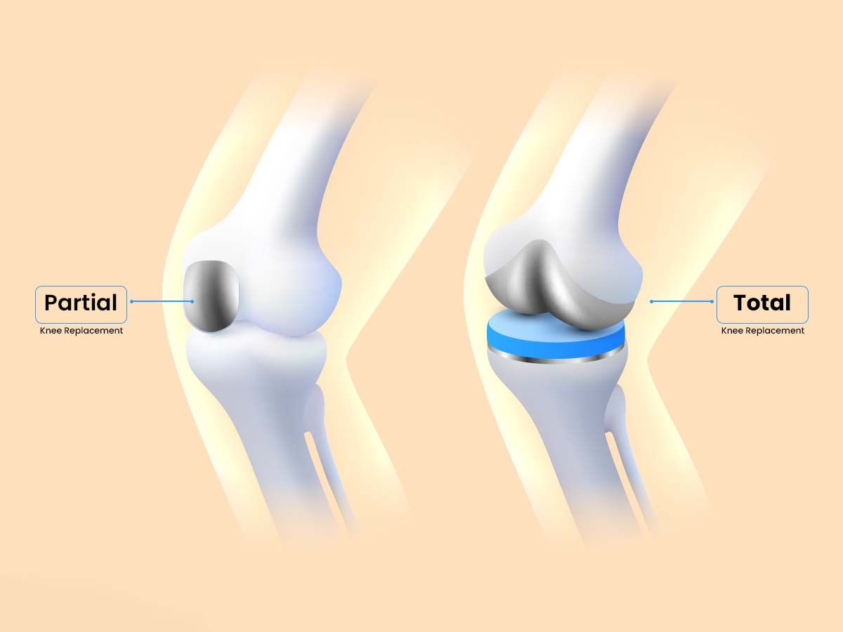 Different-knee-replacement-surgeries_-partial-total-and-revision