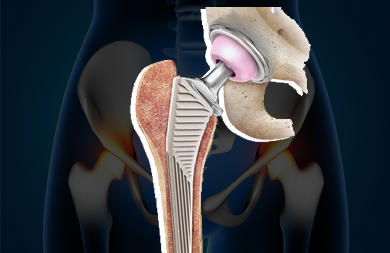 RevisionTotalHipReplacement