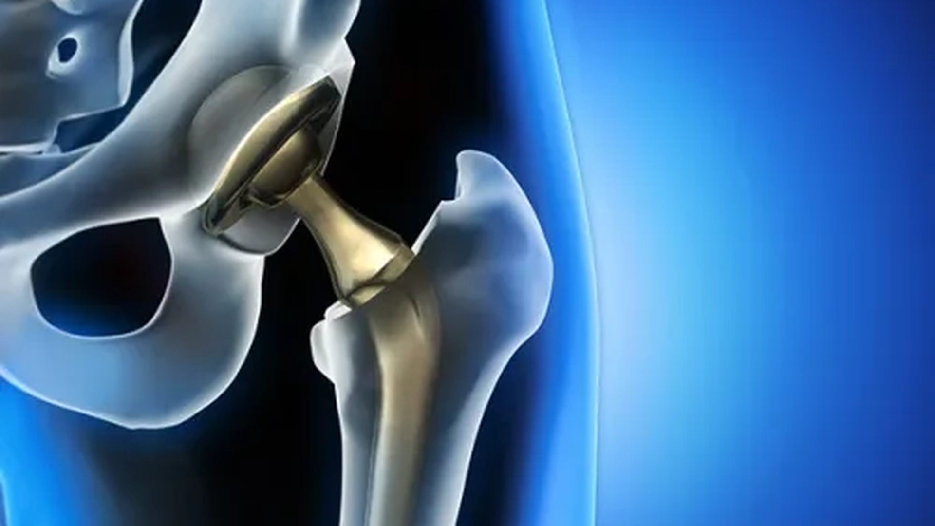 Robotic-Hip-Replacement-Surgery